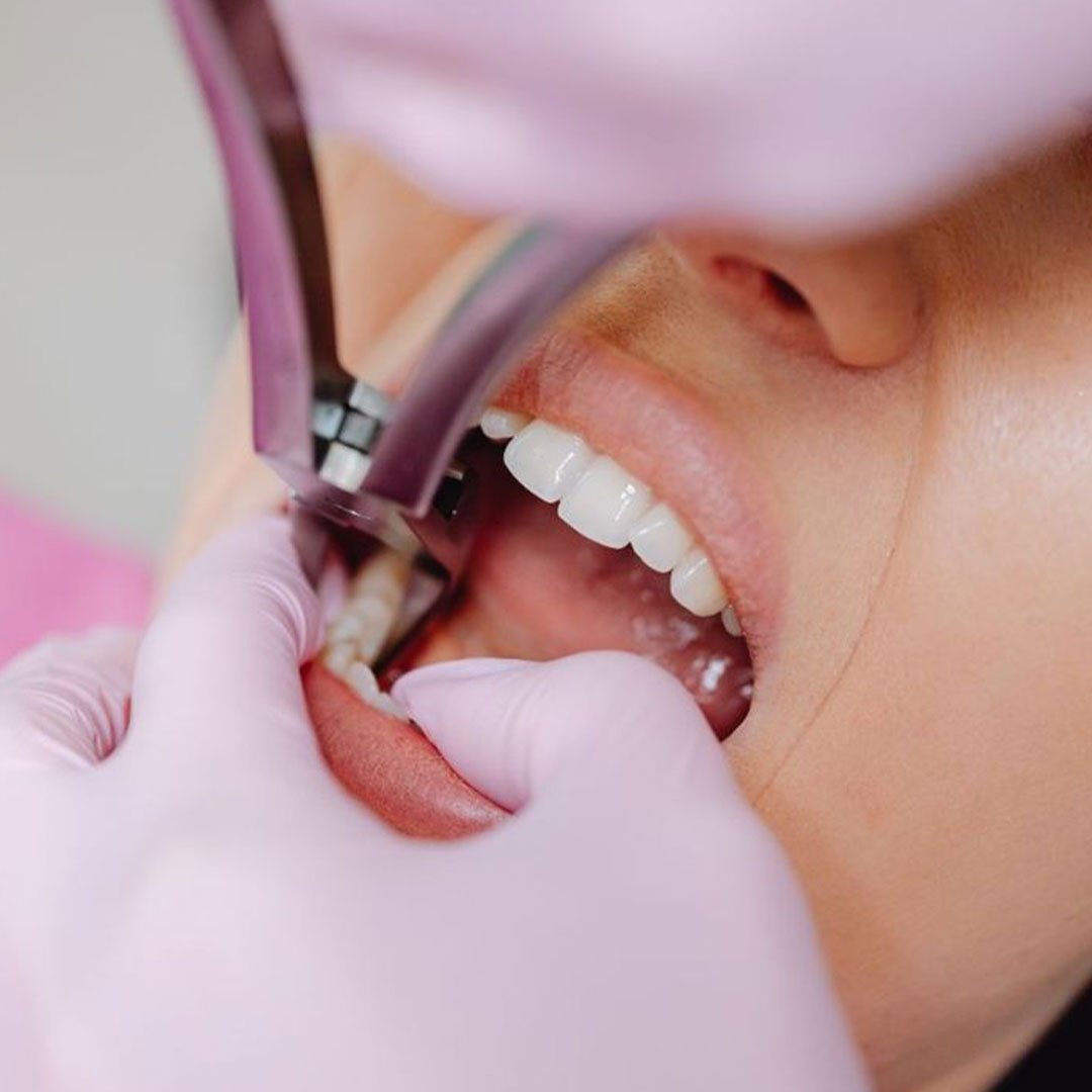 Safe and gentle tooth extraction services at Mission Dental Care.