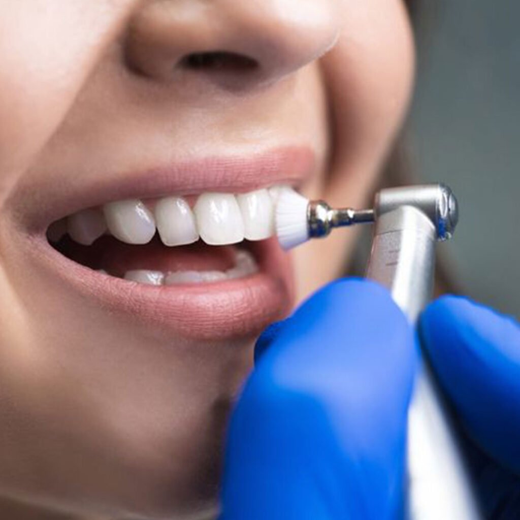 A professional dental cleaning in Oceanside CA at Mission Dental Care for healthy gums and teeth.